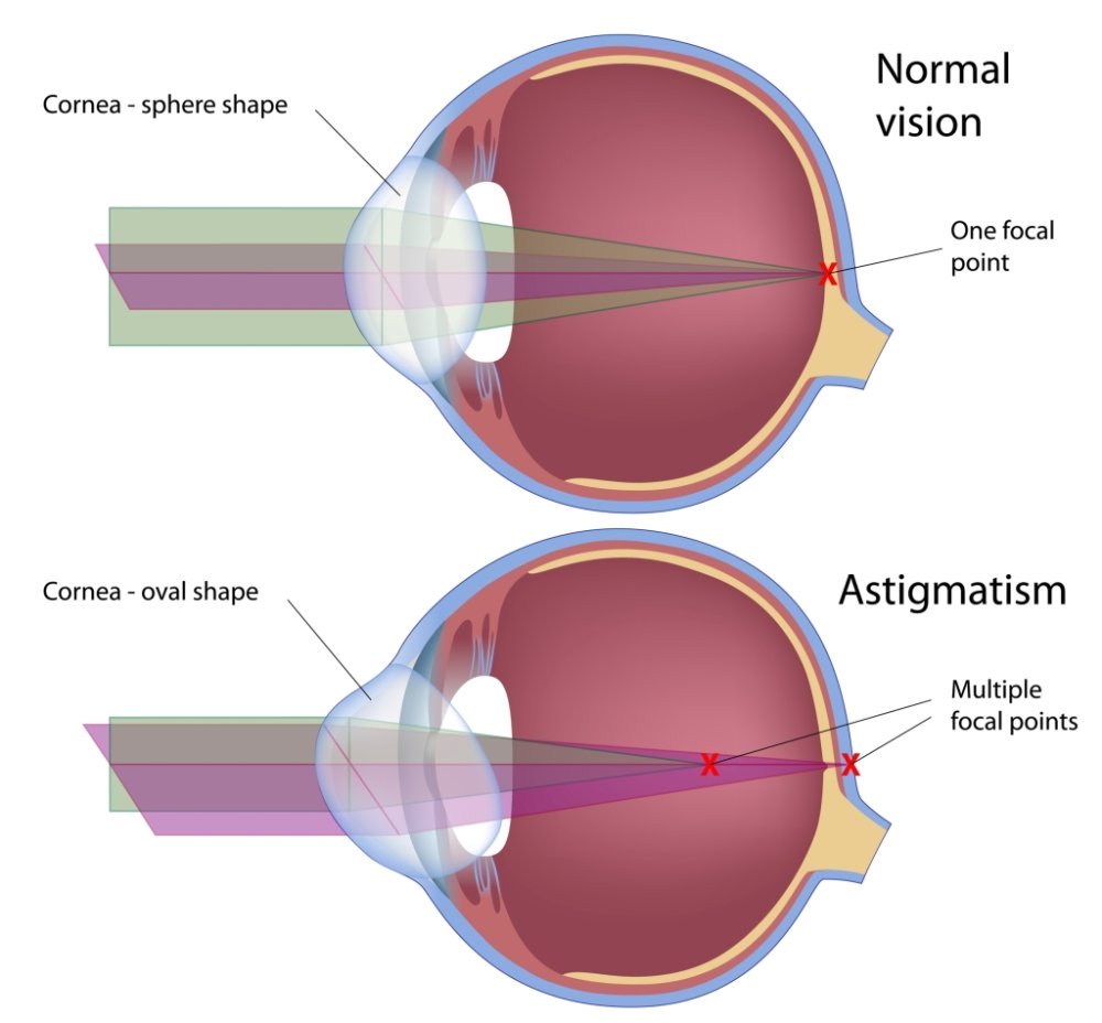 astigmatismo